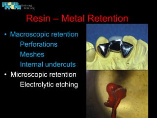 Resin – Metal Retention
•  Macroscopic retention
Perforations
Meshes
Internal undercuts
• Microscopic retention
Electrolytic etching
 