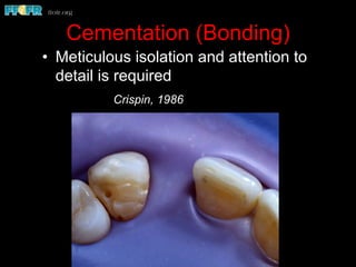 Cementation (Bonding)
•  Meticulous isolation and attention to
detail is required
Crispin, 1986
 