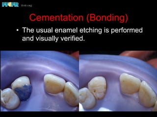 Cementation (Bonding)
•  The usual enamel etching is performed
and visually verified.
 