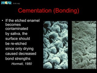 Cementation (Bonding)
•  If the etched enamel
becomes
contaminated
by saliva, the
surface should
be re-etched
since only drying
caused decreased
bond strengths
Hormati, 1980
 