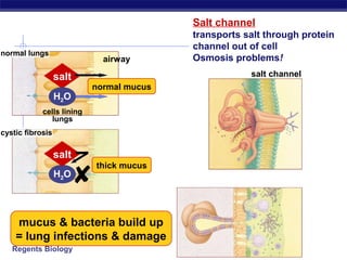 Regents Biology
Salt channel
transports salt through protein
channel out of cell
Osmosis problems!airway
salt
H2O
H2O
salt
normal lungs
cystic fibrosis
cells lining
lungs
salt channel
normal mucus
thick mucus
mucus & bacteria build up
= lung infections & damage

 