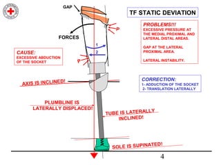 Transfemoral Static Alignment | PPT