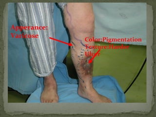 Apperance:
Varicose
Color:Pigmentation
Texture:Harder
Ulcer
 