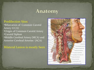 Predilection Sites:
•Bifurcation of Common Carotid
Artery (CCA)
•Origin of Common Carotid Artery
•Carotid Siphon
•Middle Cerebral Artery (MCA) and
Anterior Cerebral Arteries (ACA)
Bilateral Lesion is mostly Seen
 