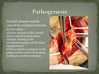 Carotid plaques mainly
caused by cerebral ischemia
in two ways ：
a.Severe stenosis of the carotid
artery caused hemodynamic
changes, leading to the
corresponding parts of the brain
hypoperfusion ；
b.Micro-emboli or plaques in the
plaque surface micro-thrombosis
leading to cerebral embolism
 