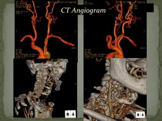 CT Angiogram
 