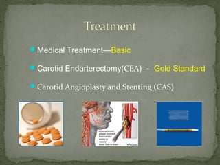 Medical Treatment—Basic
Carotid Endarterectomy(CEA) － Gold Standard
Carotid Angioplasty and Stenting (CAS)
 