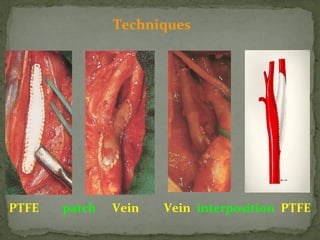 Techniques
PTFE patch Vein Vein interposition PTFE
 