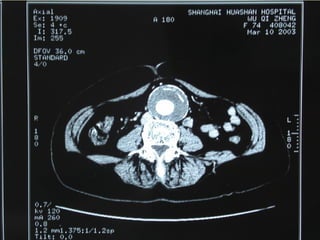 10/20/15山血管外科网华 www.vascularcenter.cn 80
 