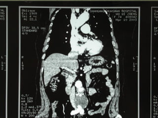 10/20/15山血管外科网华 www.vascularcenter.cn 81
 
