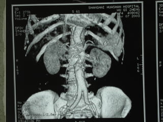 10/20/15山血管外科网华 www.vascularcenter.cn 82
 