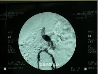 10/20/15山血管外科网华 www.vascularcenter.cn 84
脉造影动 DSA
 