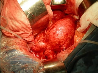 10/20/15山血管外科网华 www.vascularcenter.cn 85
 