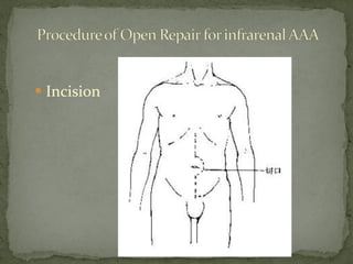  Incision
 