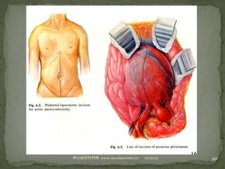 10/20/15山血管外科网华 www.vascularcenter.cn 90
 