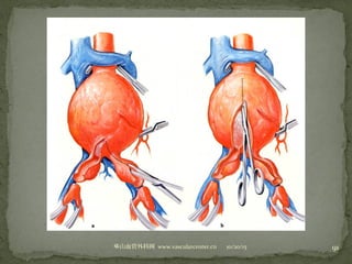 10/20/15山血管外科网华 www.vascularcenter.cn 91
 