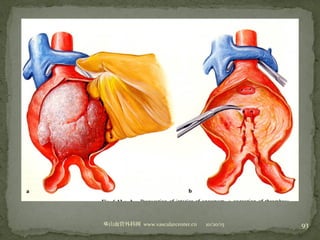 10/20/15山血管外科网华 www.vascularcenter.cn 93
 