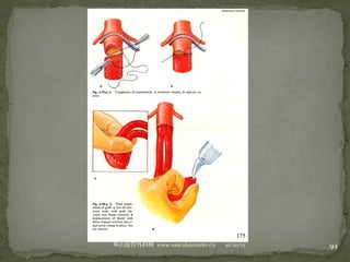 10/20/15山血管外科网华 www.vascularcenter.cn 94
 