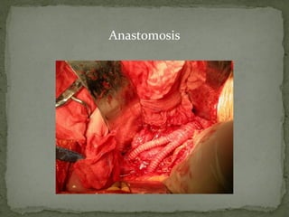 Anastomosis
 