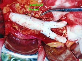 10/20/15山血管外科网华 www.vascularcenter.cn 96
Artificial
Veseel
 