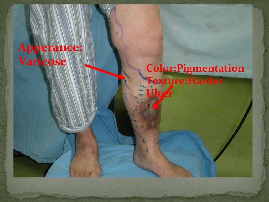 Peripheral Vascular Disease peripheral-vascular-disease
