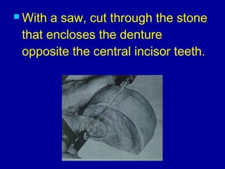  With a saw, cut through the stone
that encloses the denture
opposite the central incisor teeth.
 