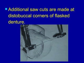  Additional saw cuts are made at
distobuccal corners of flasked
denture.
 