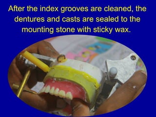 After the index grooves are cleaned, the
dentures and casts are sealed to the
mounting stone with sticky wax.
 
