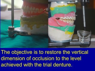 The objective is to restore the vertical
dimension of occlusion to the level
achieved with the trial denture.
 