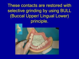 These contacts are restored with
selective grinding by using BULL
(Buccal Upper/ Lingual Lower)
principle.
 