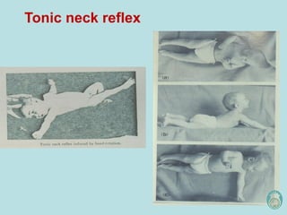 Tonic neck reflex
 