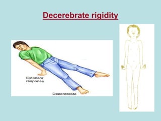 Decerebrate rigidity
 