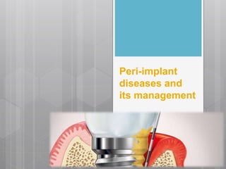 Peri-implant
diseases and
its management
 