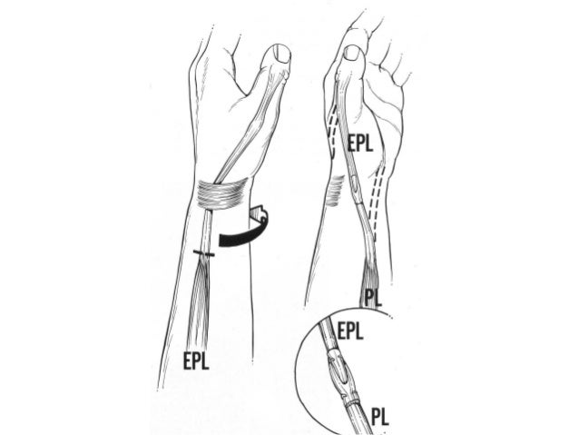 12 Tendon Transfers