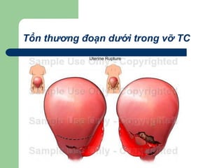 Tổn thương đoạn dưới trong vỡ TC
 