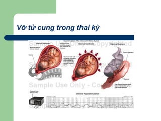 Vỡ tử cung trong thai kỳ
 