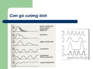 Cơn gò cường tính
 