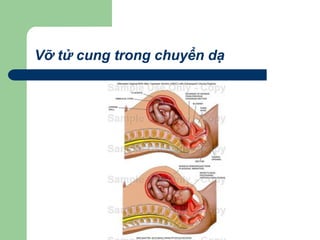 Vỡ tử cung trong chuyển dạ
 