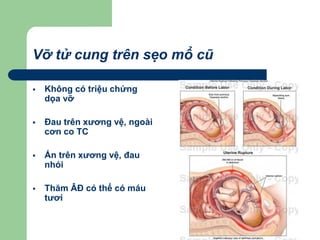 Vỡ tử cung trên sẹo mổ cũ
 Không có triệu chứng
dọa vỡ
 Đau trên xương vệ, ngoài
cơn co TC
 Ấn trên xương vệ, đau
nhói
 Thăm ÂĐ có thể có máu
tươi
 