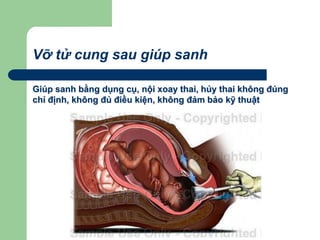 Vỡ tử cung sau giúp sanh
Giúp sanh bằng dụng cụ, nội xoay thai, hủy thai không đúng
chỉ định, không đủ điều kiện, không đảm bảo kỹ thuật
 