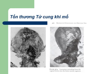 Tổn thương Tử cung khi mổ
 