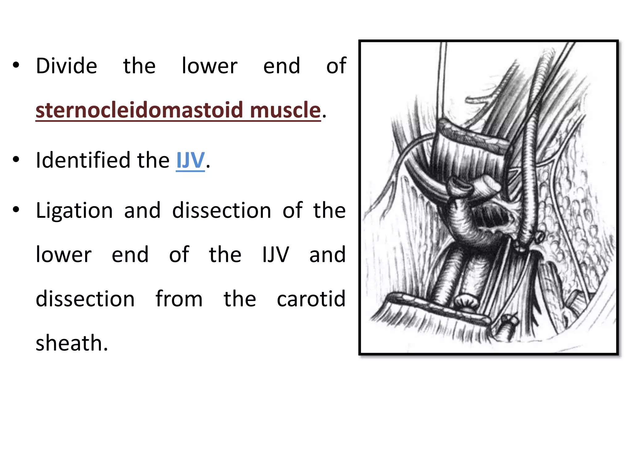 • Divide the lower end of
sternocleidomastoid muscle.
• Identified the IJV.
• Ligation and dissection of the
lower end of the IJV and
dissection from the carotid
sheath.
 