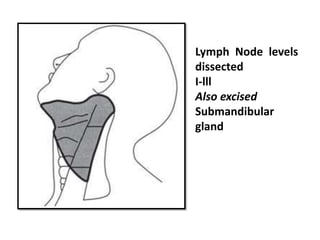 Lymph Node levels
dissected
I-lll
Also excised
Submandibular
gland
 