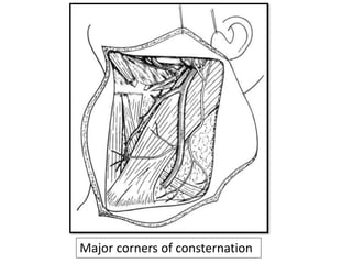 Major corners of consternation
 