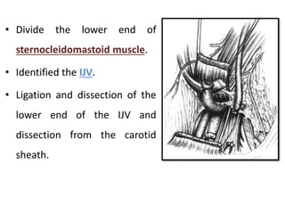 • Divide the lower end of
sternocleidomastoid muscle.
• Identified the IJV.
• Ligation and dissection of the
lower end of the IJV and
dissection from the carotid
sheath.
 
