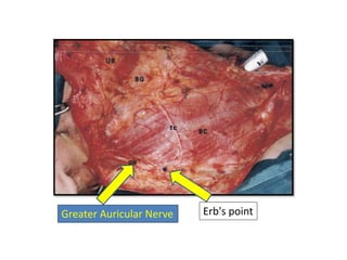 Erb's pointGreater Auricular Nerve
 