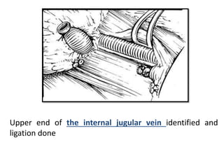 Upper end of the internal jugular vein identified and
ligation done
 