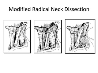 Modified Radical Neck Dissection
 
