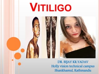 VITILIGO
DR. BIJAY KR.YADAV
Holly vision technical campus
Shankhamul, Kathmandu
 