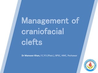 Management of
craniofacial
clefts
Dr Mansoor Khan, F.C.P.S (Plast.), BPSC, HMC, Peshawar
 